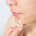 10 Best Dark Spot Removal Cream Manufacturers In India1